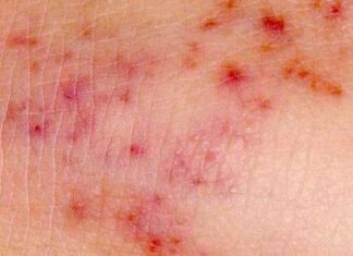 10 Common Symptoms Of Meningitis You May Not Know signs of Meningitis