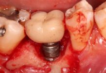 what to know about dental implants