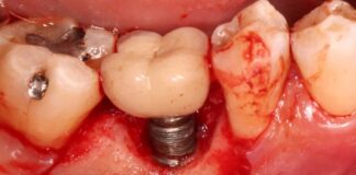 what to know about dental implants